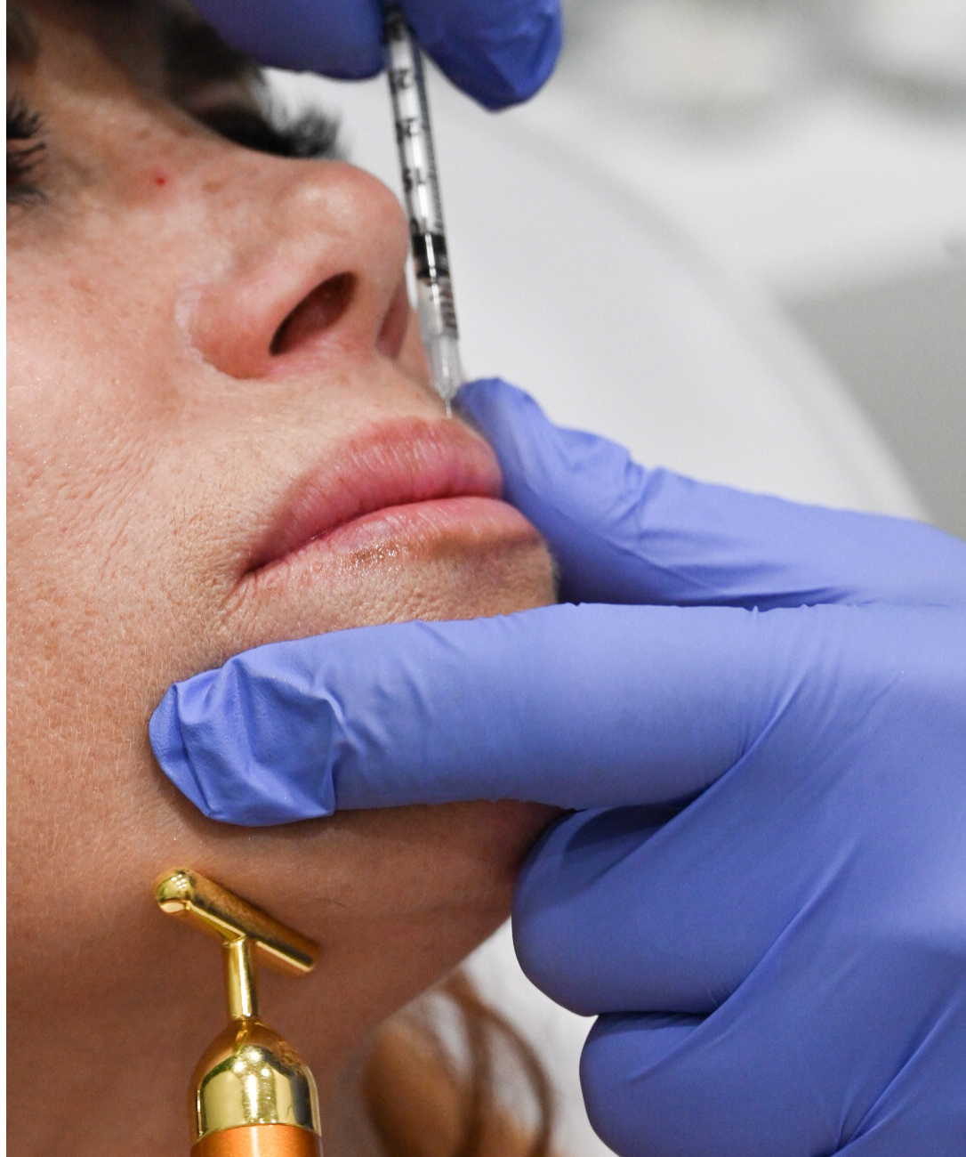 Botox in Miami: Everything You Need to Know Before Your First Treatment